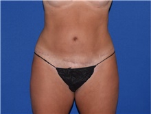 Tummy Tuck After Photo by Karol Gutowski, MD, FACS; Glenview, IL - Case 39125