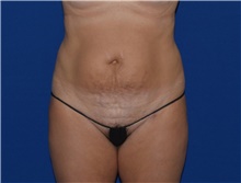 Tummy Tuck Before Photo by Karol Gutowski, MD, FACS; Glenview, IL - Case 39125