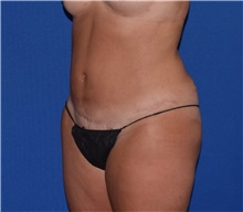 Tummy Tuck After Photo by Karol Gutowski, MD, FACS; Glenview, IL - Case 39125