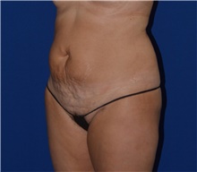 Tummy Tuck Before Photo by Karol Gutowski, MD, FACS; Glenview, IL - Case 39125