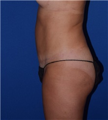 Tummy Tuck After Photo by Karol Gutowski, MD, FACS; Glenview, IL - Case 39125