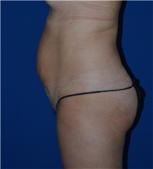 Tummy Tuck Before Photo by Karol Gutowski, MD, FACS; Glenview, IL - Case 39125