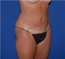 Tummy Tuck After Photo by Karol Gutowski, MD, FACS; Glenview, IL - Case 39125