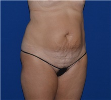 Tummy Tuck Before Photo by Karol Gutowski, MD, FACS; Glenview, IL - Case 39125