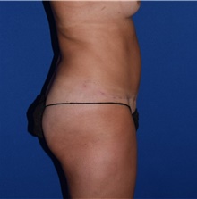 Tummy Tuck After Photo by Karol Gutowski, MD, FACS; Glenview, IL - Case 39125