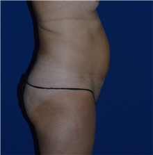 Tummy Tuck Before Photo by Karol Gutowski, MD, FACS; Glenview, IL - Case 39125