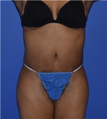 Tummy Tuck After Photo by Karol Gutowski, MD, FACS; Glenview, IL - Case 39126