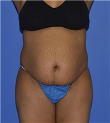 Tummy Tuck Before Photo by Karol Gutowski, MD, FACS; Glenview, IL - Case 39126