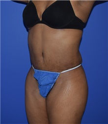 Tummy Tuck After Photo by Karol Gutowski, MD, FACS; Glenview, IL - Case 39126