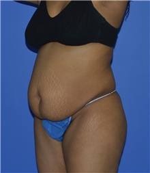 Tummy Tuck Before Photo by Karol Gutowski, MD, FACS; Glenview, IL - Case 39126