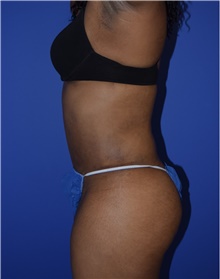 Tummy Tuck After Photo by Karol Gutowski, MD, FACS; Glenview, IL - Case 39126