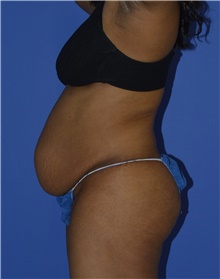 Tummy Tuck Before Photo by Karol Gutowski, MD, FACS; Glenview, IL - Case 39126