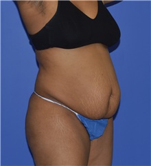 Tummy Tuck Before Photo by Karol Gutowski, MD, FACS; Glenview, IL - Case 39126