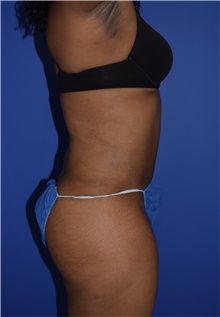 Tummy Tuck After Photo by Karol Gutowski, MD, FACS; Glenview, IL - Case 39126