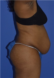 Tummy Tuck Before Photo by Karol Gutowski, MD, FACS; Glenview, IL - Case 39126