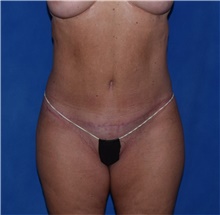 Tummy Tuck After Photo by Karol Gutowski, MD, FACS; Glenview, IL - Case 39127