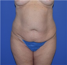 Tummy Tuck Before Photo by Karol Gutowski, MD, FACS; Glenview, IL - Case 39127