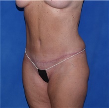 Tummy Tuck After Photo by Karol Gutowski, MD, FACS; Glenview, IL - Case 39127