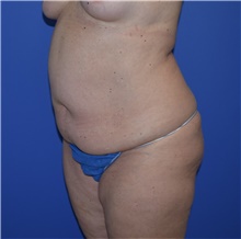 Tummy Tuck Before Photo by Karol Gutowski, MD, FACS; Glenview, IL - Case 39127