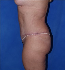 Tummy Tuck After Photo by Karol Gutowski, MD, FACS; Glenview, IL - Case 39127