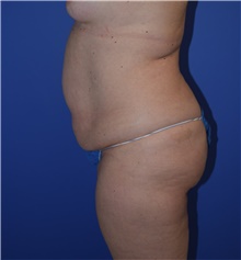 Tummy Tuck Before Photo by Karol Gutowski, MD, FACS; Glenview, IL - Case 39127