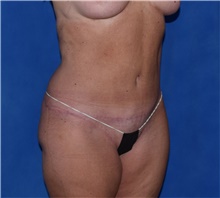 Tummy Tuck After Photo by Karol Gutowski, MD, FACS; Glenview, IL - Case 39127