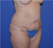 Tummy Tuck Before Photo by Karol Gutowski, MD, FACS; Glenview, IL - Case 39127