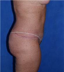 Tummy Tuck After Photo by Karol Gutowski, MD, FACS; Glenview, IL - Case 39127