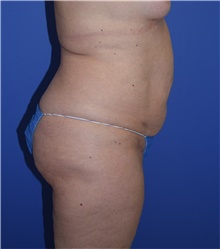 Tummy Tuck Before Photo by Karol Gutowski, MD, FACS; Glenview, IL - Case 39127