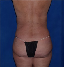 Tummy Tuck After Photo by Karol Gutowski, MD, FACS; Glenview, IL - Case 39127