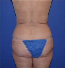 Tummy Tuck Before Photo by Karol Gutowski, MD, FACS; Glenview, IL - Case 39127