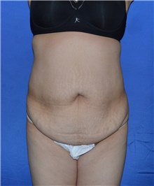 Tummy Tuck Before Photo by Karol Gutowski, MD, FACS; Glenview, IL - Case 39128