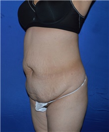 Tummy Tuck Before Photo by Karol Gutowski, MD, FACS; Glenview, IL - Case 39128