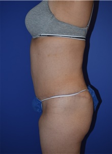 Tummy Tuck After Photo by Karol Gutowski, MD, FACS; Glenview, IL - Case 39128