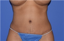 Tummy Tuck After Photo by Karol Gutowski, MD, FACS; Glenview, IL - Case 39130