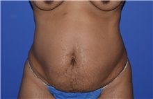 Tummy Tuck Before Photo by Karol Gutowski, MD, FACS; Glenview, IL - Case 39130