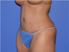 Tummy Tuck After Photo by Karol Gutowski, MD, FACS; Glenview, IL - Case 39130