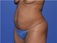 Tummy Tuck Before Photo by Karol Gutowski, MD, FACS; Glenview, IL - Case 39130