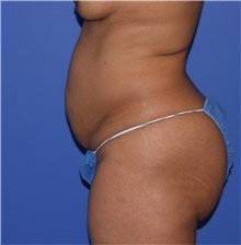 Tummy Tuck Before Photo by Karol Gutowski, MD, FACS; Glenview, IL - Case 39130