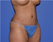 Tummy Tuck After Photo by Karol Gutowski, MD, FACS; Glenview, IL - Case 39130