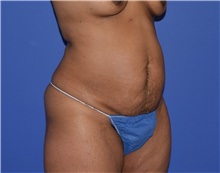 Tummy Tuck Before Photo by Karol Gutowski, MD, FACS; Glenview, IL - Case 39130