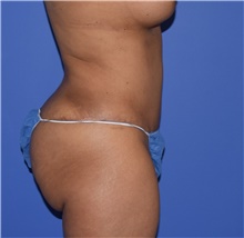 Tummy Tuck After Photo by Karol Gutowski, MD, FACS; Glenview, IL - Case 39130