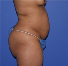 Tummy Tuck Before Photo by Karol Gutowski, MD, FACS; Glenview, IL - Case 39130