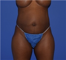 Tummy Tuck Before Photo by Karol Gutowski, MD, FACS; Glenview, IL - Case 39131