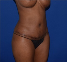 Tummy Tuck After Photo by Karol Gutowski, MD, FACS; Glenview, IL - Case 39131