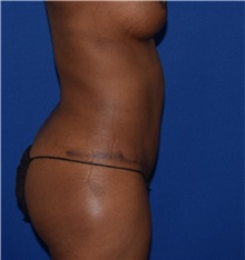 Tummy Tuck After Photo by Karol Gutowski, MD, FACS; Glenview, IL - Case 39131