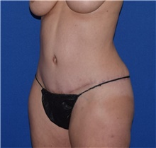 Tummy Tuck After Photo by Karol Gutowski, MD, FACS; Glenview, IL - Case 39132