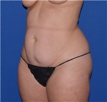 Tummy Tuck Before Photo by Karol Gutowski, MD, FACS; Glenview, IL - Case 39132