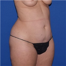 Tummy Tuck Before Photo by Karol Gutowski, MD, FACS; Glenview, IL - Case 39132