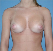 Breast Augmentation After Photo by Karol Gutowski, MD, FACS; Glenview, IL - Case 39133